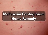 8 Effective Molluscum Contagiosum Home Remedy