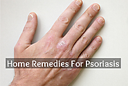 Natural Remedies For Psoriasis - Herbal Treatment For Psoriasis - Crazy Health Plan
