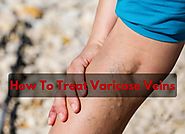 How To Treat Varicose Veins - Varicose Veins Natural Treatment
