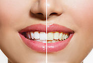 Best Teeth Whitening Treatments in Melbourne