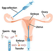 IVF Infertility Treatment in India – MedMonks