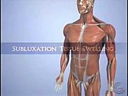Subluxation Tissue Swelling Treatment | Treatment for Vertebral Subluxation | Arcadia