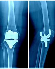 Knee Replacement in Mexico & India – Affordable, Reliable and Timely Alternative