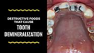 Do Not Eat The Following Foods Or Tooth Demineralization Will Grip You Violently!