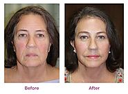 Rejuvenate Your Look with a Facelift