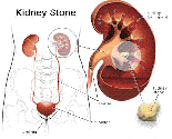 Urology Health and Wellness: Main Things you should know about Kidney Stones