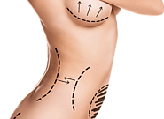 Breast Lift and Mastopexy Cost in Dubai | Breast Implants Dubai