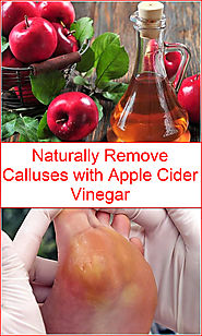 Naturally Remove Calluses with Apple Cider Vinegar | Listerine Foot Soak