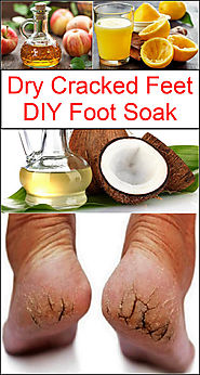 Dry Cracked Feet DIY Foot Soak | Listerine Foot Soak