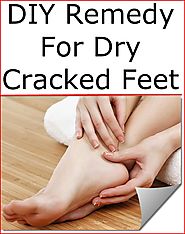 Remedy for dry feet 2025 with listerine