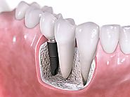 Certified Dentist | Dental Implants in Ahmedabad