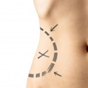 Recovery Time Of A Tummy Tuck | Cosmedical Rejuvenation Clinic