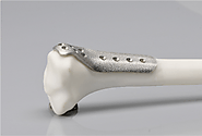 3D metal printing in medical:, bone for surgery