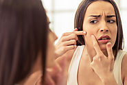 8 Habits That Worsen Your Acne Breakouts