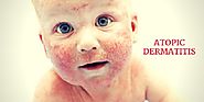Eczema in Children increase the risk of Allergies
