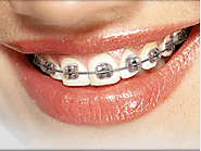 Various Kind of Braces for Adults Idaho Falls