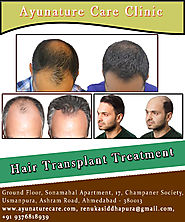 Best Hair Transplant Treatment in Ahmedabad