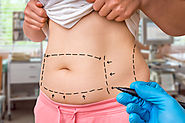 3 Questions to Ask Yourself Before Liposuction