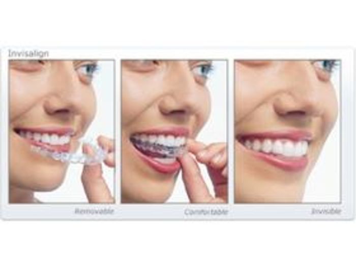 Invisalign Alternative A Listly List