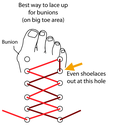 Tips for dealing with those painful foot Bumps (Bunions)