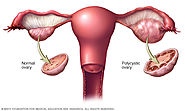 What are PCOS Symptoms And Diseases and How toTreat