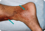 Abnormal Veins Treatment Melbourne By Veincare.com.au