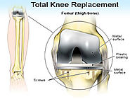 Total Knee Replacement Telangana, Knee Replacement Hyderabad, India
