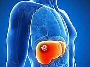Hepatic Cancer Treatment in India | MedMonks