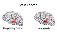 Know Everything about the Symptoms of Brain Tumor