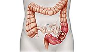Colon Cancer Treatment in India at Low Cost | MedMonks