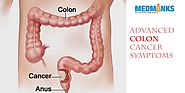 Advanced Colon Cancer Symptoms | MedMonks
