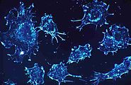 Stem Cell Therapy Treatment For Adamant Cancer Cells