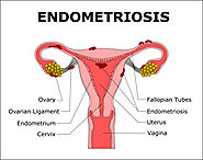 Endometriosis Surgery in Bangalore | Pelvic Pain Treatment Indiranagar