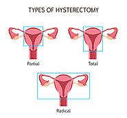 Laparoscopic Hysterectomy Bangalore,Uterus removal in India