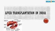 Split Liver Transplantation – MedMonks