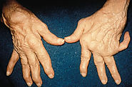 Rheumatoid Arthritis Treatment India | Rheumatoid Factor Test Coimbatore
