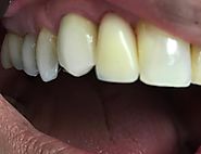Dentist in Taunton MA | Blissful Dental