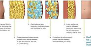 How does CoolSculpting work? - Album on Imgur