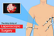The Nitty-Gritty of Laparoscopic Surgery – Heart Care Hospitals
