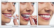 Invisalign Treatment: How Healthy Teeth Is A Key To your overall health?