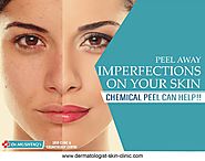 Skin Peel Treatment Kochi Kerala | Chemical Skin Peel Cochin