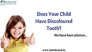 Treatment for Tooth Discoloration Thrissur | Tooth Bleaching Kerala