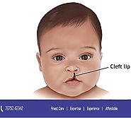 Best Cleft Lip Surgery in Hyderabad | Dinesh Dental Paradise