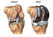 Knee Replacement Surgery in India with Best Price