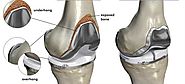 What is the minimum cost for Knee Replacement in India?
