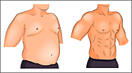Know more about Male Breast Reduction or Gynecomastia