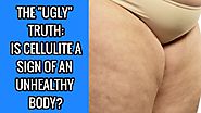 The Ugly Truth- Is Cellulite A Sign Of An Unhealthy Body?