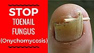 5 Natural Nail Fungus Treatments to Stop Onychomycosis - How to Get Rid of Toenail Fungus Fast