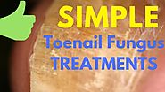 Nail Fungus Treatment - Simple Natural Steps to Treat Toenail Fungus From Home