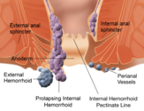 Hemorrhoid - Wikipedia, the free encyclopedia